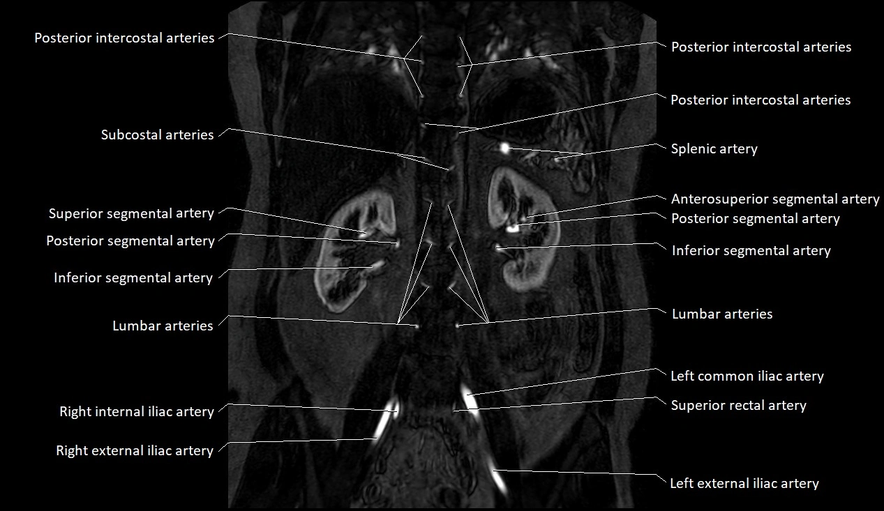 MRA Abdomen coronal anatomy image 30.webp